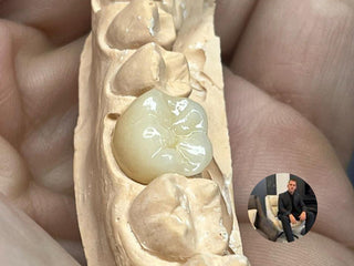 2024-12-17 case:   From:Brazilian   Author:Bruno  Material:Lithium disilicate ingot