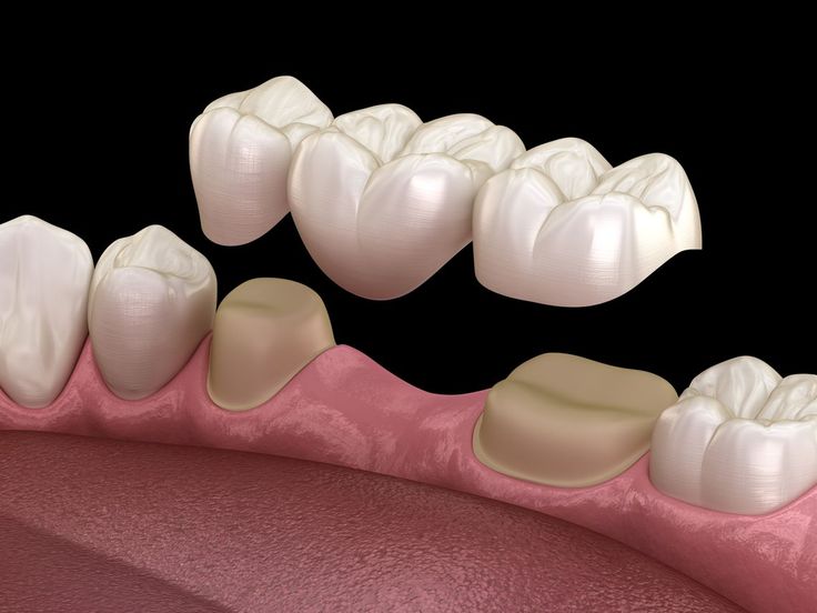 The effect of core and veneer porcelain thickness on the flexural strength of all-ceramic restorations
