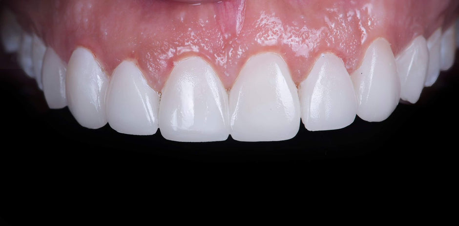 Clinical application of using lithium disilicate glass ceramic to restore small anterior tooth