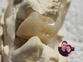 2025-01-04 case:   From:Chile   Author:Macarena  Material:Lithium disilicate