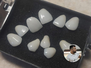2024-12-25 case:   From:Mexico   Author:Pedro  Material:Lithium disilicate ingot
