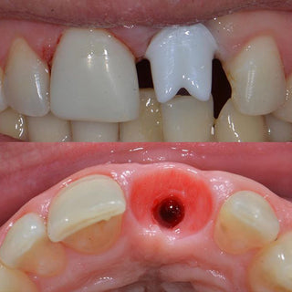 Sistema Zirkonzahn em bloco de zircônia branca HT 95mm