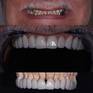 Bloques de disilicato de litio (vitrocerámica): C14/B32/B40-HT/LT (5 piezas) 