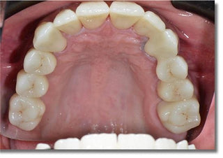 ST+Color Precolored Zirconia Block Zirkonzahn System 95mm