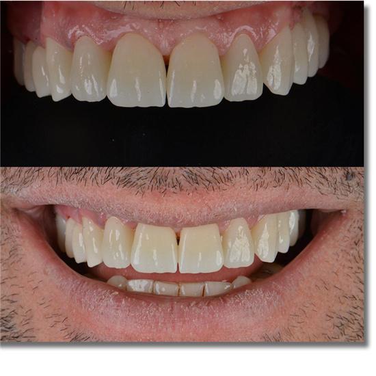 ST+C Precolored  Zirconia Block AG System  71mm