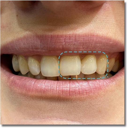 UTEx Pro Multilayer zirconia Blocks-Color Bleach